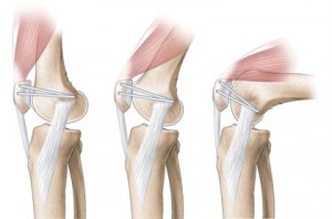 artroza femuro patelara când articulațiile picioarelor doare la mers