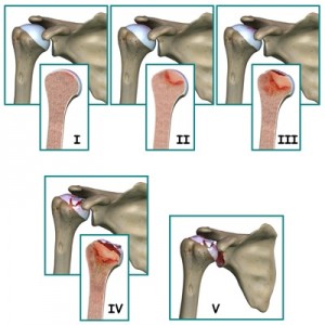 humeral_head_osteonecrosis_stages