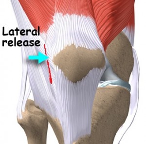 Artroza genunchiului și articulației patello-femurale.