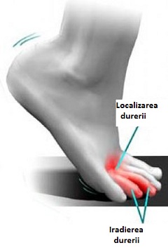 artroza eficientă a genunchiului