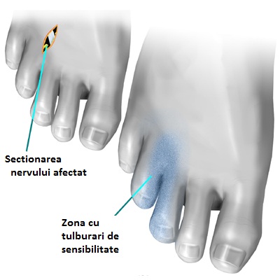 Amorteala degetelor de la picioare poate anunta Sindromul Morton