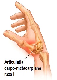 osteoartrita articulației carpometacarpiane