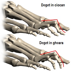 inflamația zonelor simptomului articulației piciorului stadiul 4 artroza șoldului