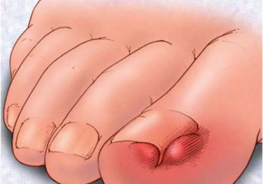 recenzii de san glucozamină condroitină articulația pe degetul mic doare