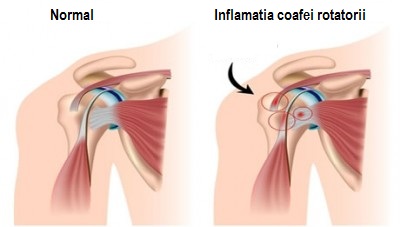 Durere de umăr – cauze, diagnostic, tratament