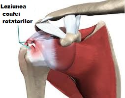 blocarea durerilor articulare ale umărului după blocadă inflamație purulentă a articulației cotului