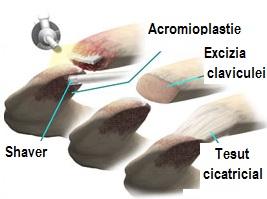 Articulațiile claviculare, Artroza articulației acromio-claviculară