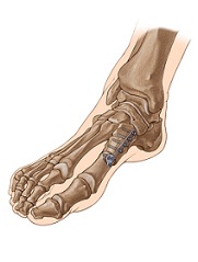 artrodeza restaurării articulației gleznei tratamentul ligamentelor medicamentelor articulației genunchiului