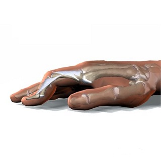 deteriorarea articulației degetelor în urma șocului umflarea ligamentelor gleznei