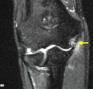 leziuni ale ligamentului cotului disfuncția articulației artritei reumatoide