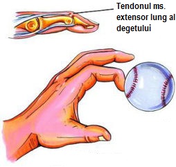 leziunea articulației degetului mijlociu)