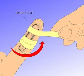 cum să tratezi o articulație pe degetul mic
