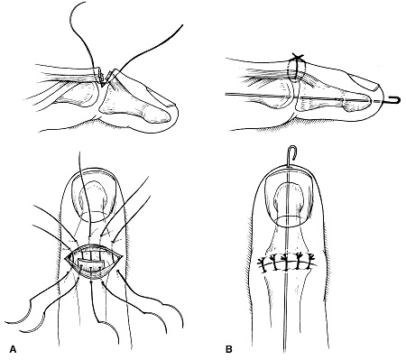 tratament de entezopatie a articulațiilor genunchiului tratamentul cu unguent pentru artroza degetelor