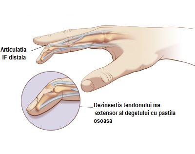 Tratamentul leziunilor articulare degetul mare