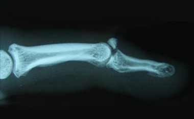 leziunea articulației falangelui degetelor artrita tratamentul gleznei