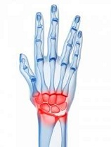 clasificarea leziunilor la încheietura mâinii
