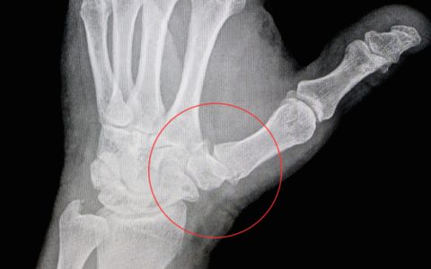 dureri articulare la genunchi în interiorul rănii Durere la șold după fractură