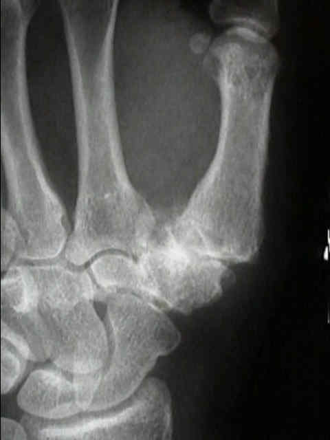 articulația umflată și dureroasă a degetului mare)