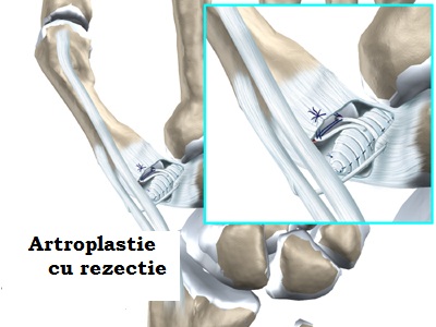 tratamentul artrozei deplasării articulațiile rănite de la pantovigar