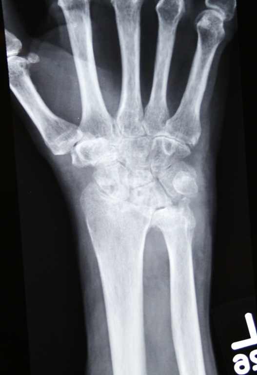 osteoartrita deformatoare a articulației încheieturii mâinii