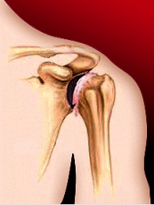 artrita deformantă a tratamentului articulațiilor umărului