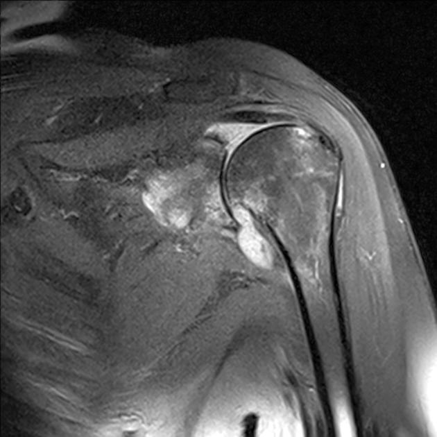artroza humerală articulații dureroase la nivelul spatelui inferior