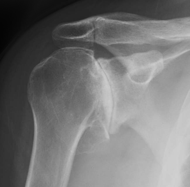 artroza deformantă a tratamentului articulației acromioclaviculare