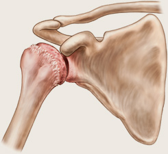 artroza deformată a articulației umărului drept
