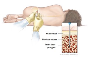 artroză recenzii ale tratamentului cu celule stem umflarea articulațiilor gleznei cauza