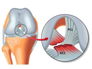 Ruptura de ligamente la genunchi - primul ajutor