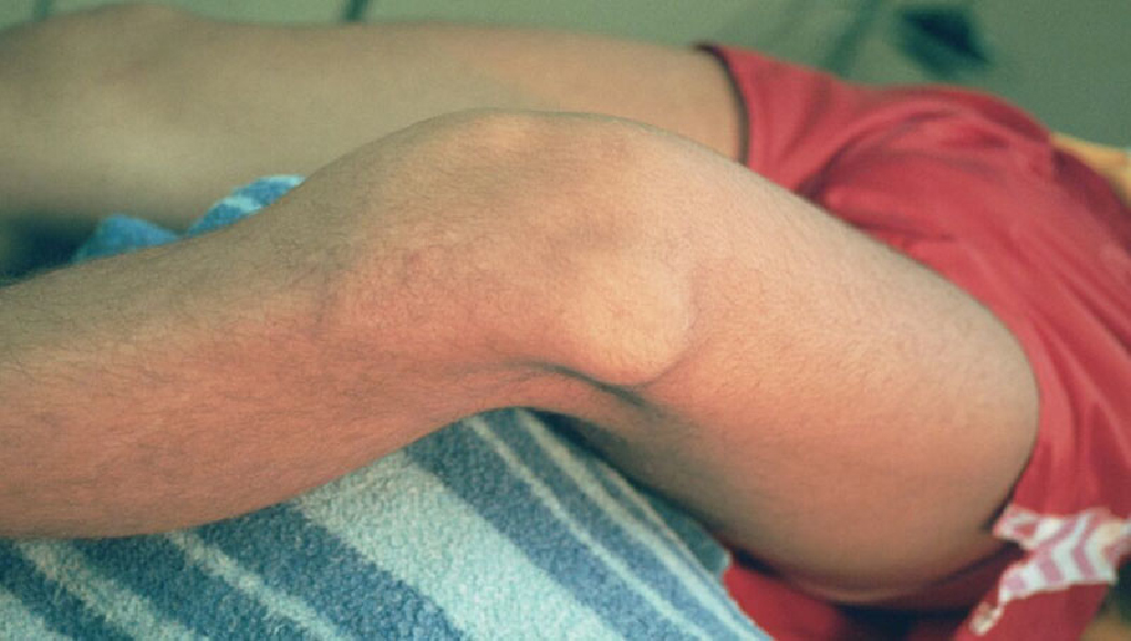 umflarea articulației genunchiului cu luxație)
