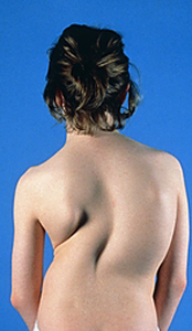 ^BScoliosis.^b Back view of an adolescent girl with severe scoliosis - sideways curvature of the spine. Scoliosis usually starts in childhood or adolescence, becoming progressively worse until growth stops. In many cases another part of the spine bends in an opposite direction to compensate, resulting in an S-shape. The cause of scoliosis is often unknown (idiopathic scoliosis). If the curvature is slight the spine may be left untreated. Severe or progressive scoliosis may be treated by immobilization of the spine followed by surgery to fuse affected bones into a straight line.