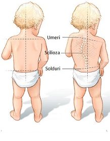Scolioza