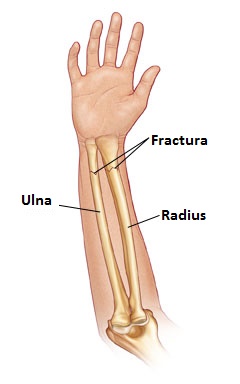 Anterior view of forearm showing fractures of the radius and ulna referenced from WWW: http://www.wheelessonline.com/ortho/pediatric_distal_radius_fracture Atlas of Human Anatomy, 2nd ed., Netter