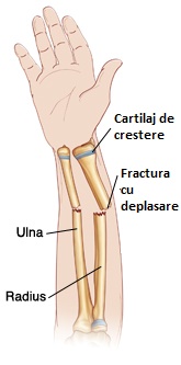 Anterior view of forearm with growth plates showing a Displaced fracture of the Radius and Ulna referenced from WWW: http://www.wheelessonline.com/ortho/pediatric_distal_radius_fracture Atlas of Human Anatomy, 2nd ed., Netter