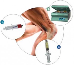 acp-therapie-schematische-darstellung