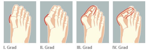 hallux