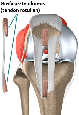 knee_acl_patellar_tendon_rationale01