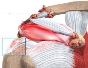 shoulder_calcific_anatomy02a