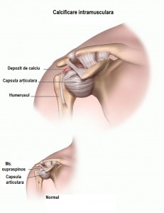 calcific_2