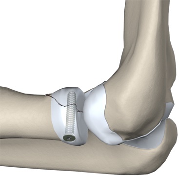 adult_elbow_fx_radial_head_screw