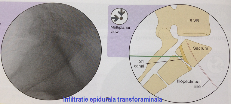 epidurala 3