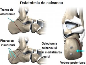 foot_acquired_flatfoot_surgery3