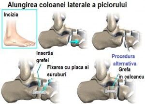 foot_acquired_flatfoot_surgery4