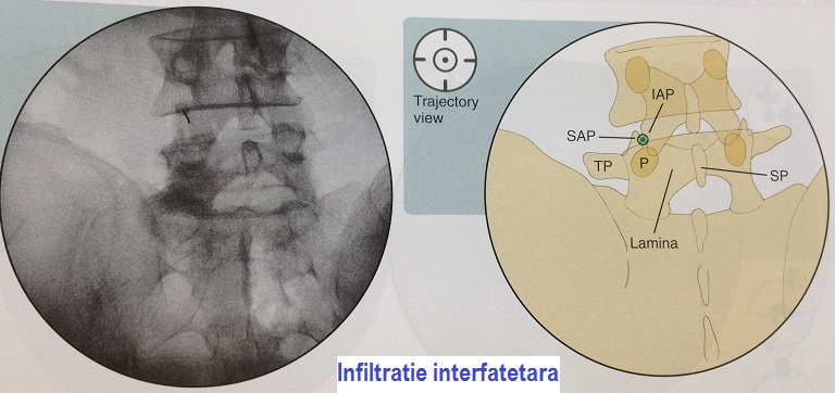 interfatetara 2