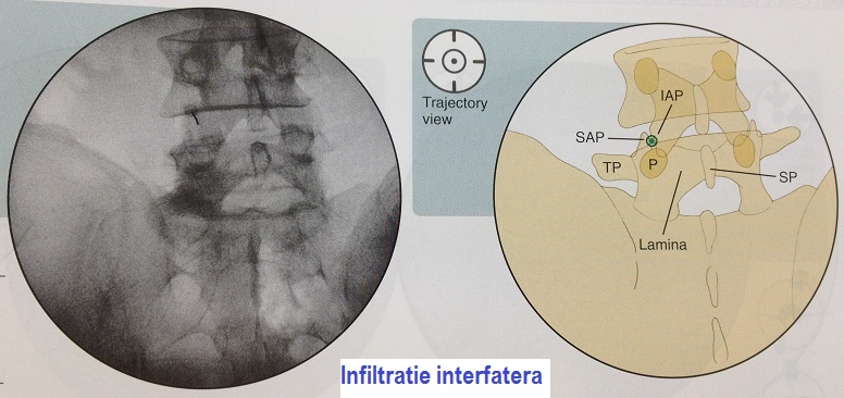 interfatetara 3