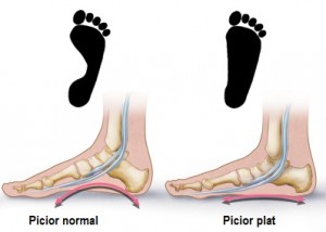 mcdc7_flatfeet