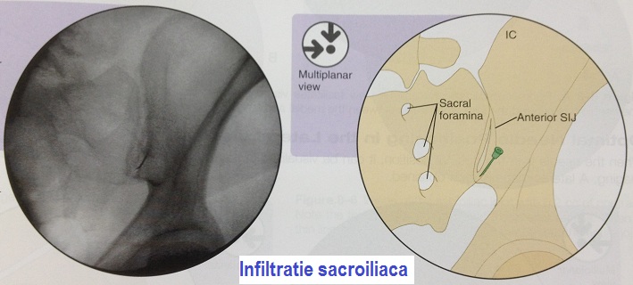 sacroiliaca 2