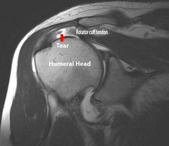 mri_cuff_tear