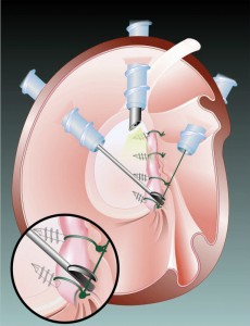 Arthroscopic-Bankart-Lesion-Repair